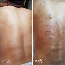 טיפול באקנה פצעים בגב לפני-ואחרי